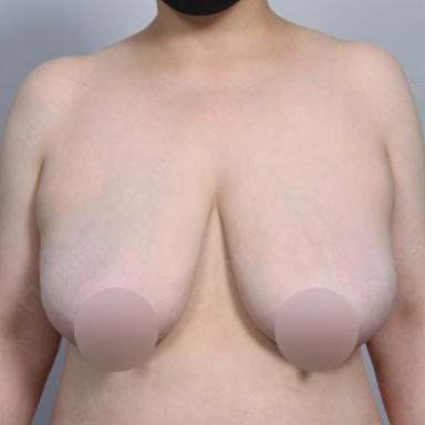 Korean breast reduction before photo showing enlarged and sagging breasts with low nipple position.
