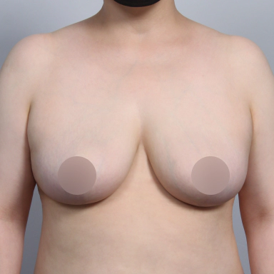 Korean breast reduction after photo showing lifted, smaller breasts with improved contour and symmetry.