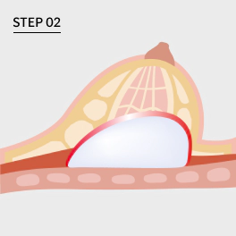 Illustration of inserting endoscope to gain view step for Korean breast revision surgery.