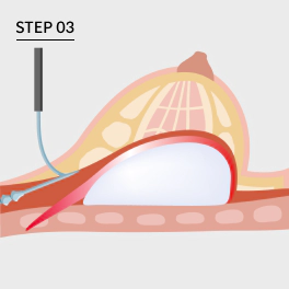 Illustration of removing capsule surrounding the breast step for Korean breast revision surgery.