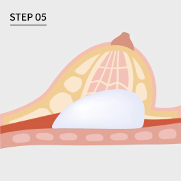 Illustration of inserting new implant step for Korean breast revision surgery.