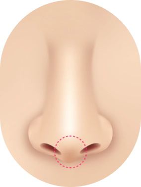 Revision rhinoplasty is needed when the nose tip becomes droopy.