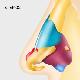 Wing cartilage position after tip plasty.