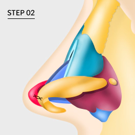 Tip plasty with septal cartilage fixation.