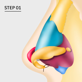 How to do tip plasty with cartilage graft.