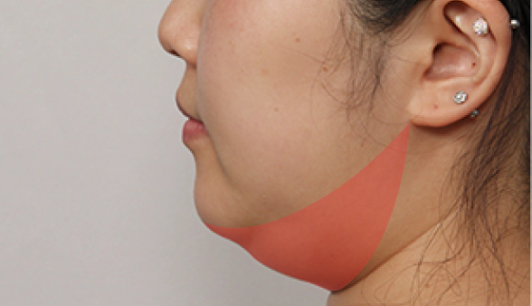 Patient with thick Korean double chin that is good candidate for mini neck lift for Korean jawline lifting.