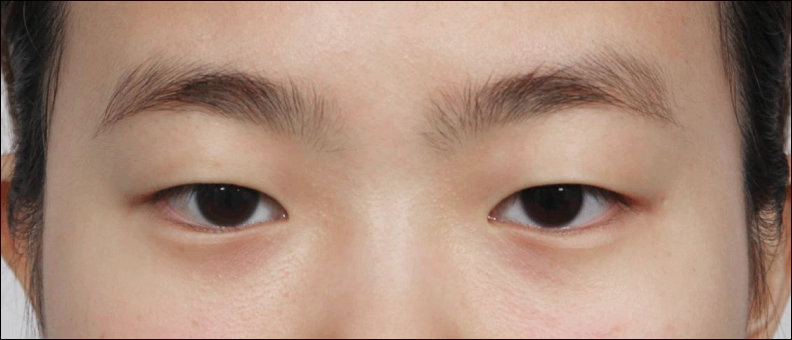 몽고주름이 명확한 눈 피부과 쳐져 눈을 가리고 있는 여성.