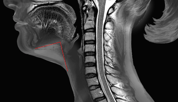 Difference that is possible with Korean double chin surgery and deep neck fat removal.
