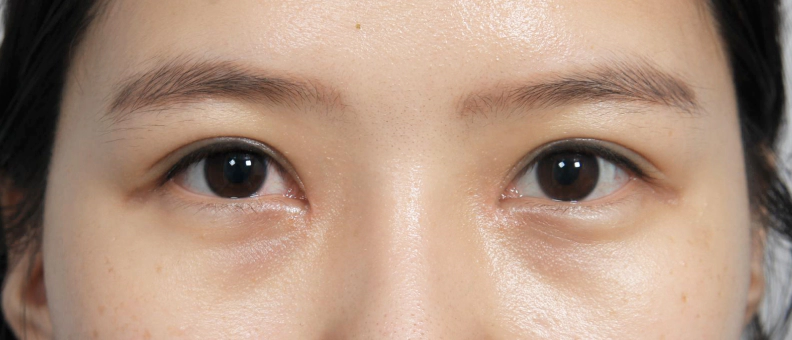 쌍꺼풀 수술후 쌍꺼풀 라인이 잘 잡힌 여성.