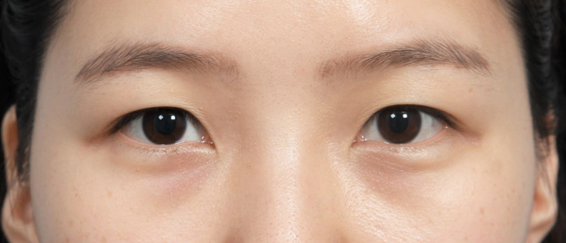 쌍꺼풀 수술전 라인이 거의 없는 여성.