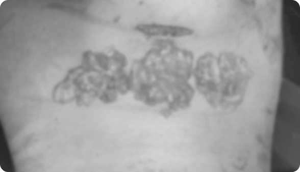 Fat blocks that were actually removed during Korean double chin surgery deep neck fat removal.