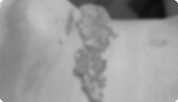 Image of fat blocks that were actually removed during double chin surgery deep neck fat removal.