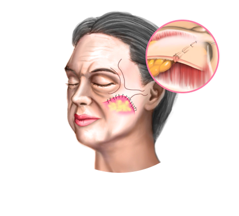 If the skin is thin and face is hollow SMAS plication is used for Korean facelift.