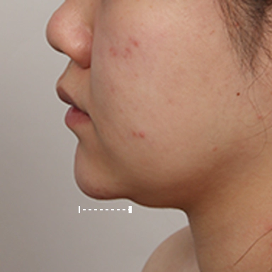 Chin that looks that look short due to Korean double chin.
