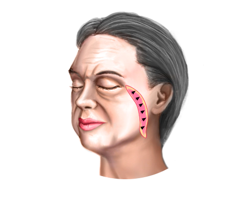 Smas ectomy Korena facelift method for thick and hard skin.