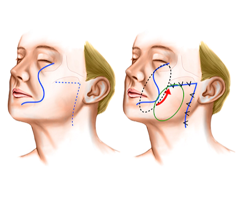 Low smas Korean facelift for sagging cheeks.