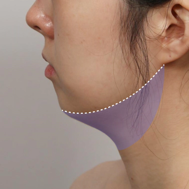 A sloped Korean double chin that is a turkey neck case.