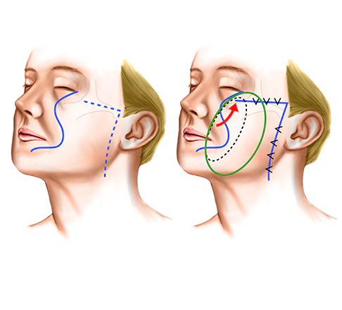 High smas Korean facelift for overall sagging face.
