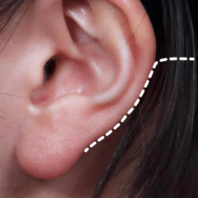 Korean jawline lifting, Korean neck lift, and mini neck lift incision line.