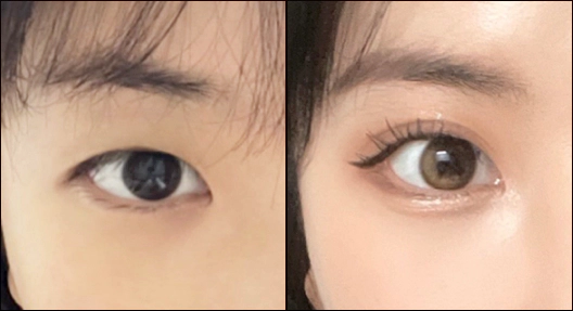 Double eyelid before and after.