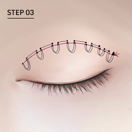 Non incision double eyelid surgery fixation points suture.