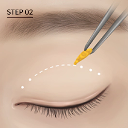 Removing extra fat from eyelid during partial incision double eyelid surgery.