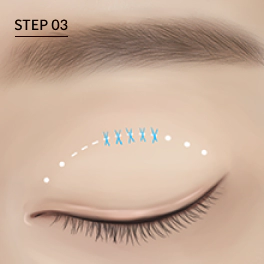 Partial Incision double eyelid fixation method.