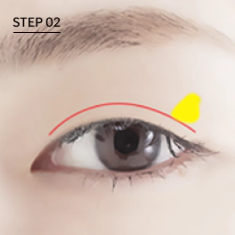 Make incision and remove extra fat during ptosis correction surgery.