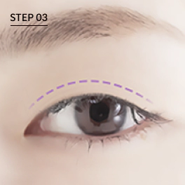 Correct the eye opening muscles during ptosis correction.