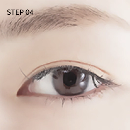In-and-out line double eyelid.
