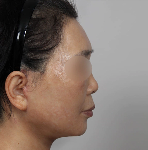 Lifted face and neck after antiaging Korean facelift and neck lift.