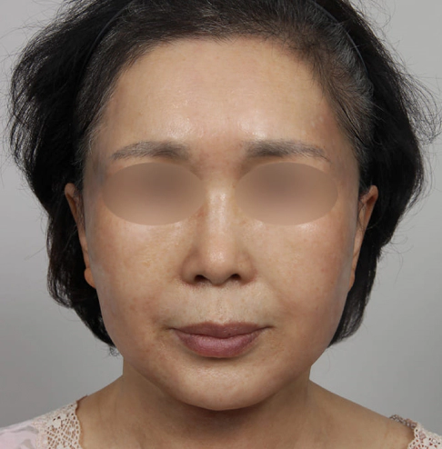 A youthful face achieved after Korean facelift.