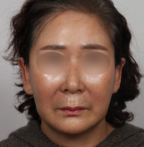 Female with youthful front cheek volume and shorter smile line after Korean facelift and neck lift.