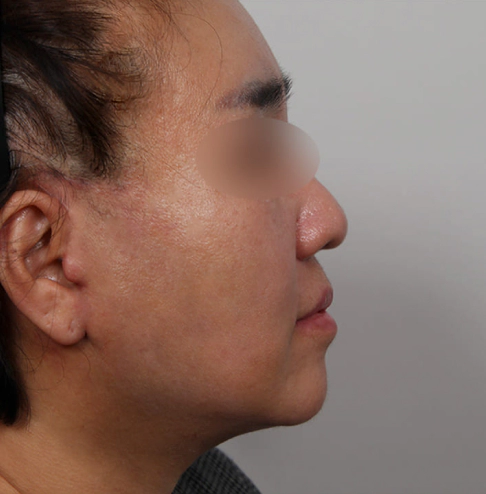 Improved neck and jawline after Korean facelift and neck lift surgery.