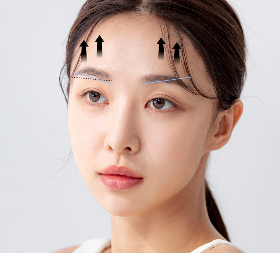 이마 거상술에서 쳐진 눈썹을 올리는 방향.