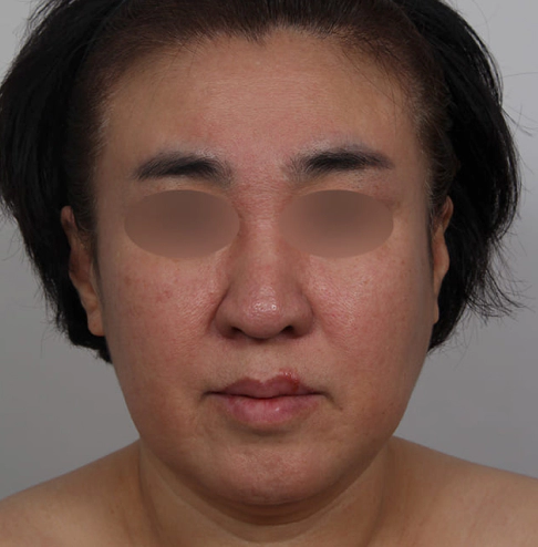 Female with a sagging fat and droopy neck skin before Korean facelift surgery.