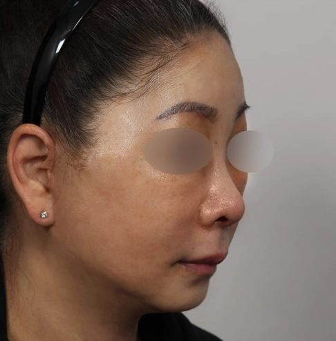 Improved smile line and marionette line after Korean facelift surgery at MINE Plastic Surgery.