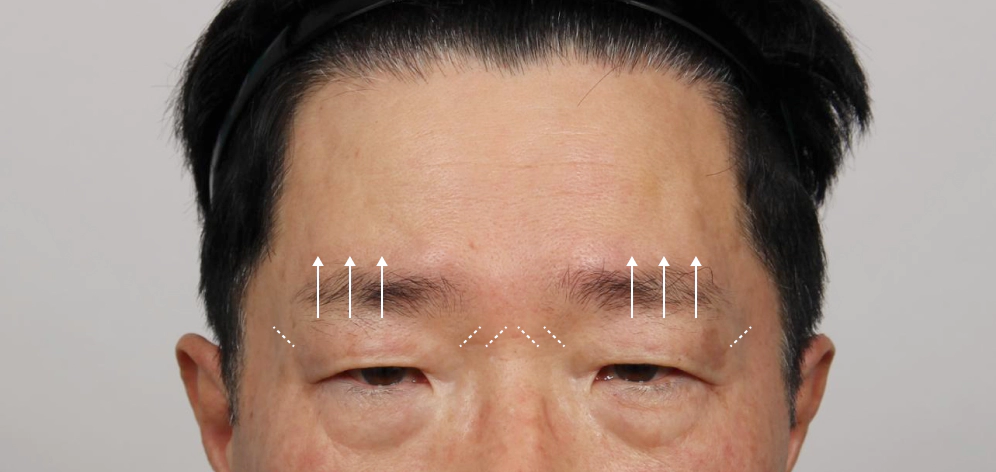 이마거상술로 쳐진눈과 주름진 이마 개선 방향.