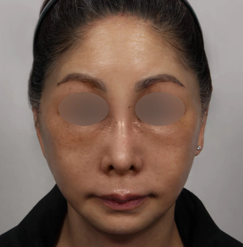 Female who has done forehead lift, Korean facelift, and neck lift.