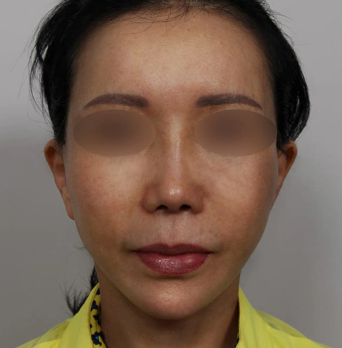 Improved jawline and face line after Korean facelift and neck lift.