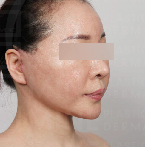 Smooth jawline and rejuvenated young face after Korean facelift and neck lift.