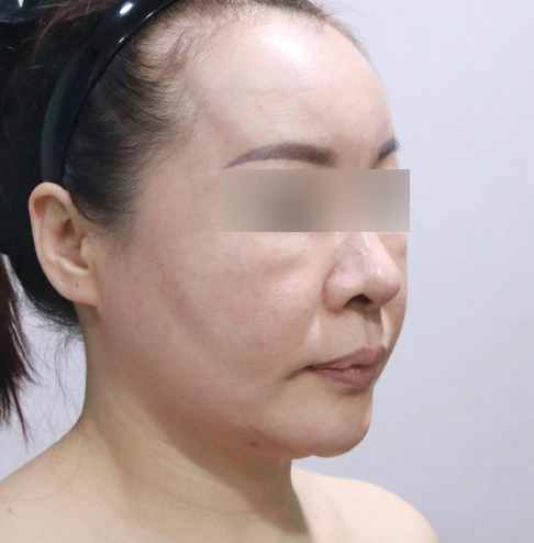 Female with sagging skin under the eyes, mid cheek, and jawline in need of Korean facelift surgery.
