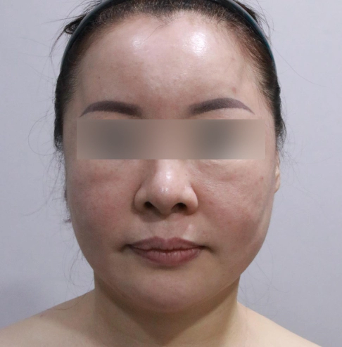 Old female that needs Korean facelift because she doesn't like her sagging cheek and jawline.