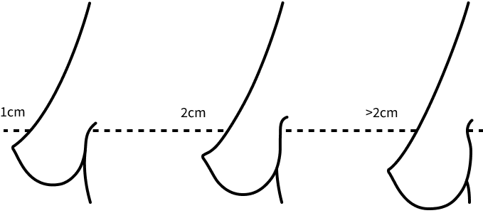 Korean breast lift stage 3 sagging.