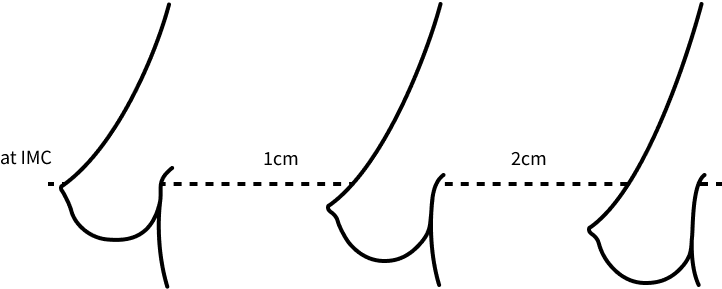 Korean breast lift stage 2 sagging.