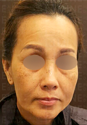 나이들어 팔자주금과 마리오넷 라인이 깊어진 중년 여성.