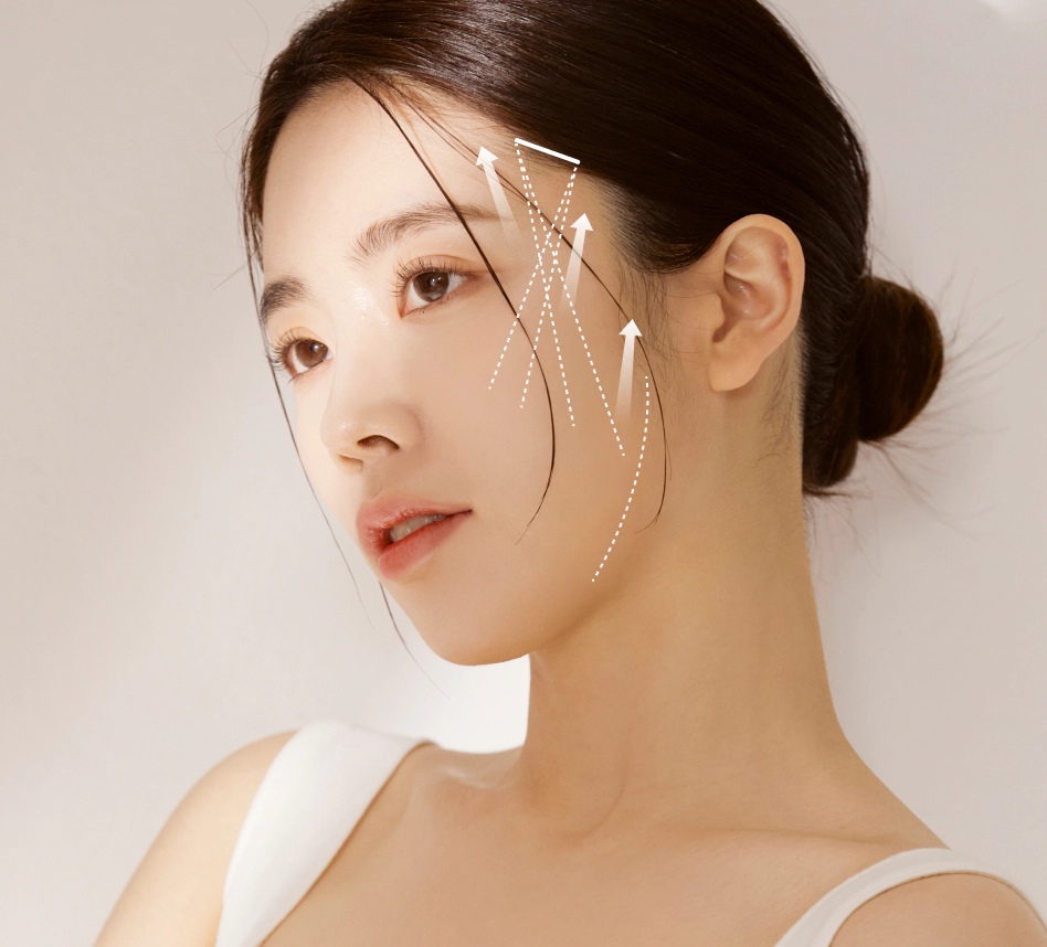 실리프팅으로 쳐진 얼굴 고정하는 방향.