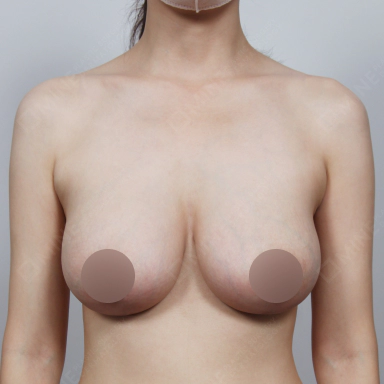 Breast that are lifted and have more volume after Korean breast lift.