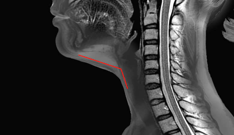 Korean jawline lifting MRI image outlining the improvement possible with liposuction.