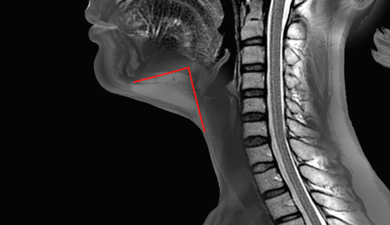 Korean jawline lifting MRI diagram showing reduced fat volume and improved jawline after submuscular fat removal.